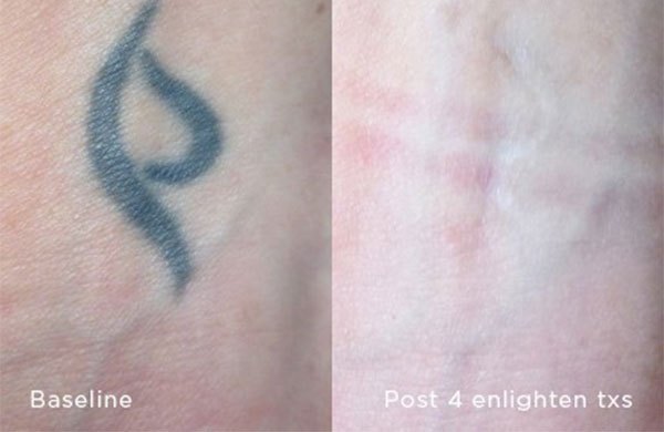 Laser-Tattoo-Removal-2-720