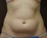 SmartLipo