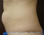 SmartLipo