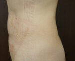 SmartLipo