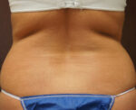 SmartLipo