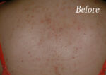 Chemical Peels