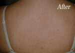 Chemical Peels