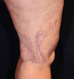 Leg Veins