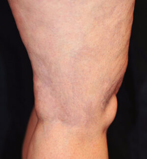 Leg Veins