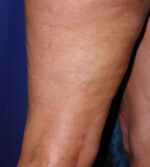 Leg Veins