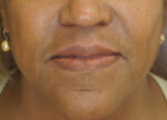 Fillers