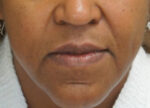 Fillers