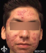 Accutane