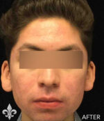 Accutane