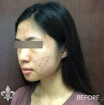 Accutane