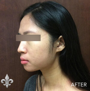 Accutane