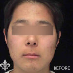 Accutane