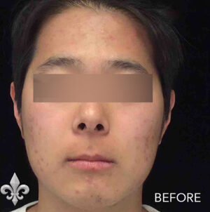 Accutane