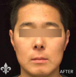 Accutane