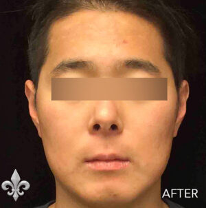 Accutane