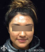 Accutane