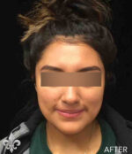 Accutane