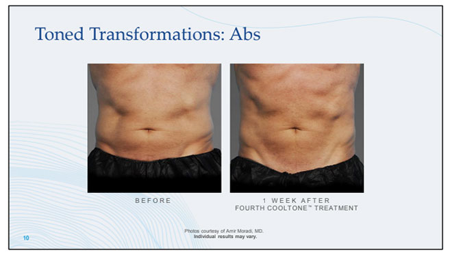 Toned Transformations: Abs Before and After CoolTone Treatment Photos