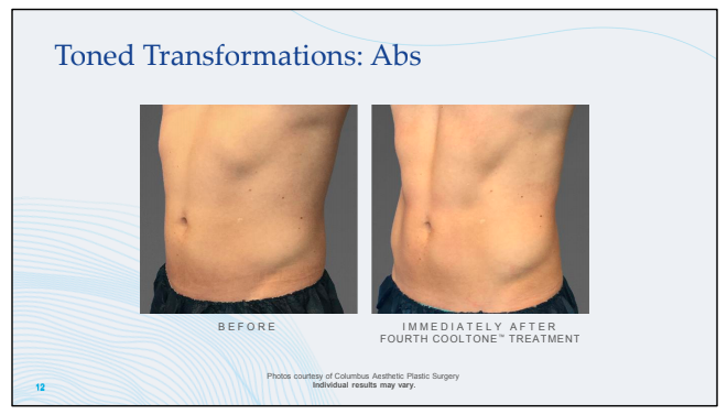 Toned Transformations: Abs Before and After CoolTone Treatment Photos